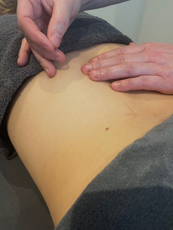Acupuncturist die een naald in de rug van een vrouw steekt. Patiënt die een traditionele Chinese behandeling krijgt waarbij gebruik wordt gemaakt van naalden om de energiestroom door specifieke punten op de huid te herstellen.